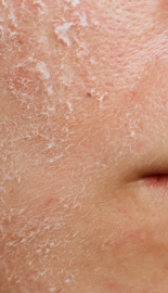 눈에 띄는 각질/요철