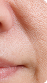 깊어진 미세주름